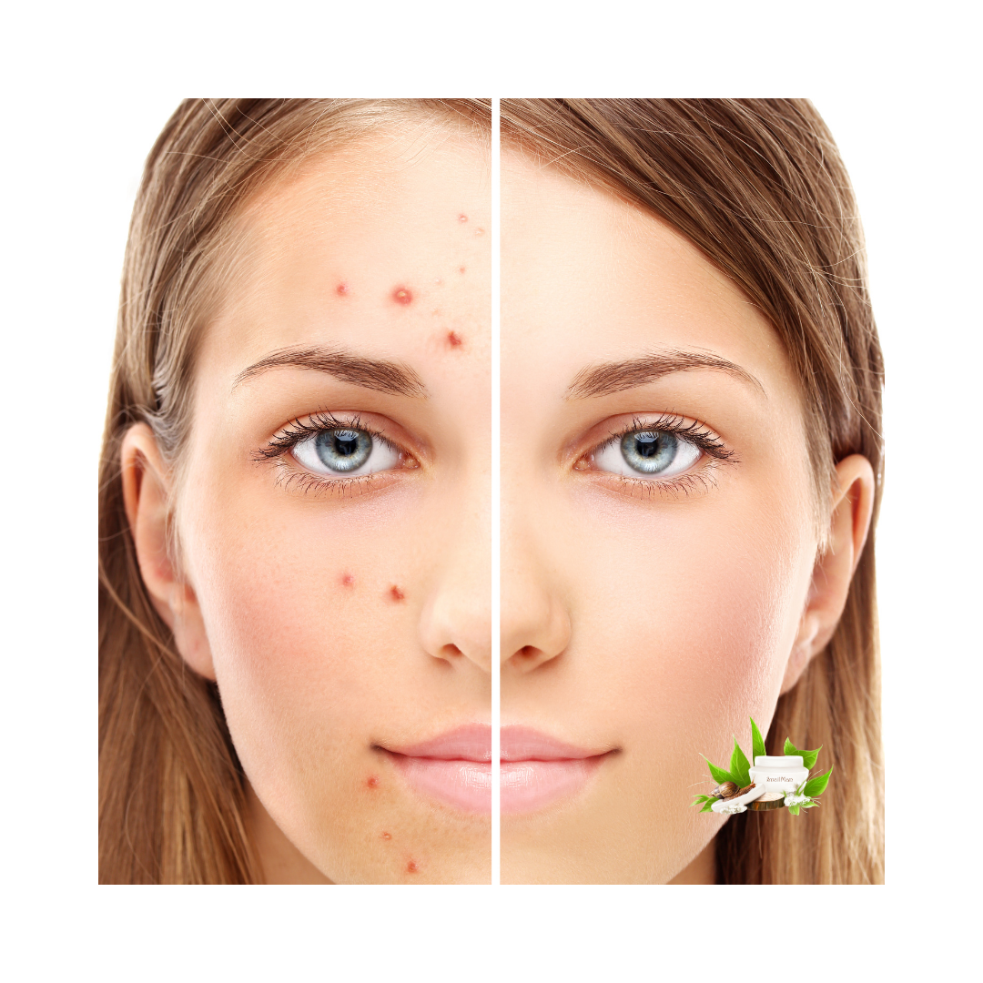 Лечение на упорито акне